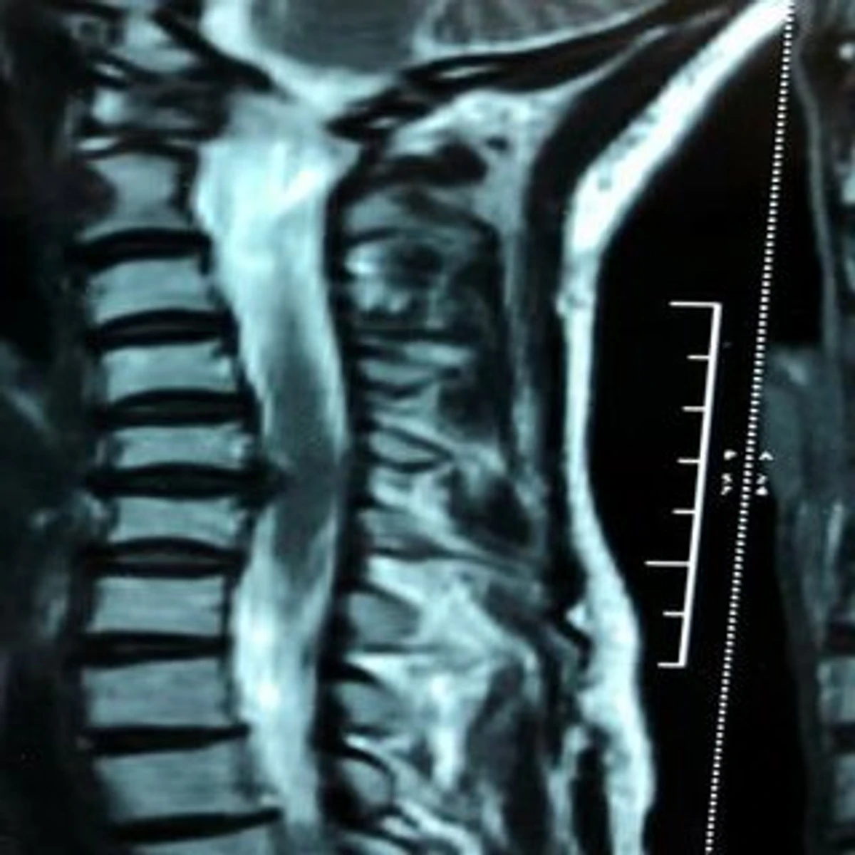Mri of whiplash injury.